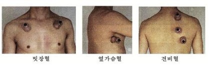 자연정혈요법 이미지