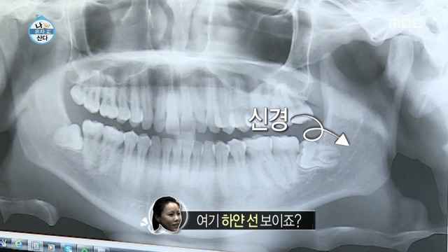 [나혼자산다] 너도나도 공감하는 공포의 사랑니 빼기 | 인스티즈
